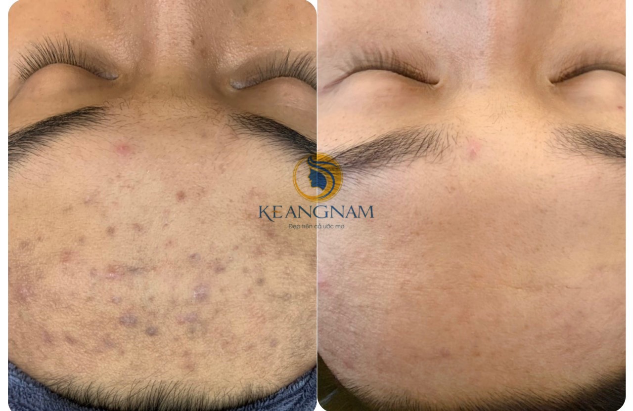 kết quả trước sau của các khách hàng điều trị tại Thẩm Mỹ Keangnam Sóc Sơn số 1
