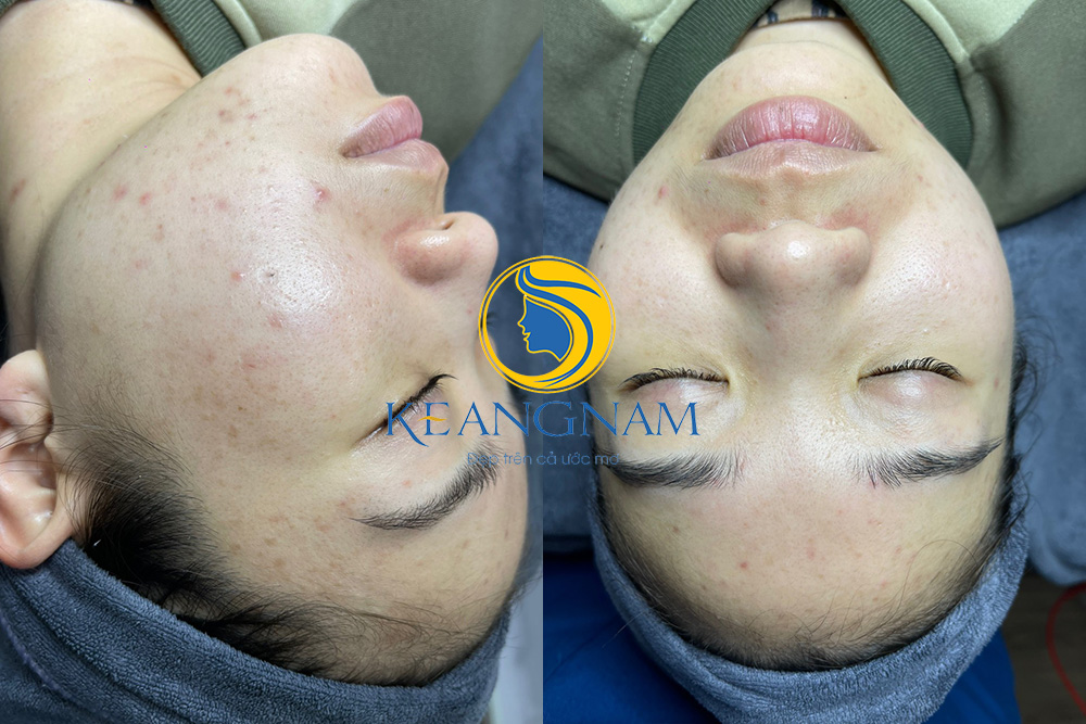 kết quả trước sau của các khách hàng điều trị tại Thẩm Mỹ Keangnam Sóc Sơn số 2