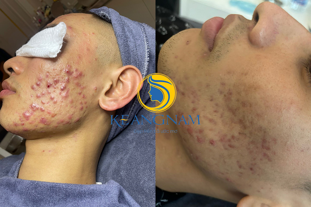 kết quả trước sau của các khách hàng điều trị tại Thẩm Mỹ Keangnam Sóc Sơn số 3