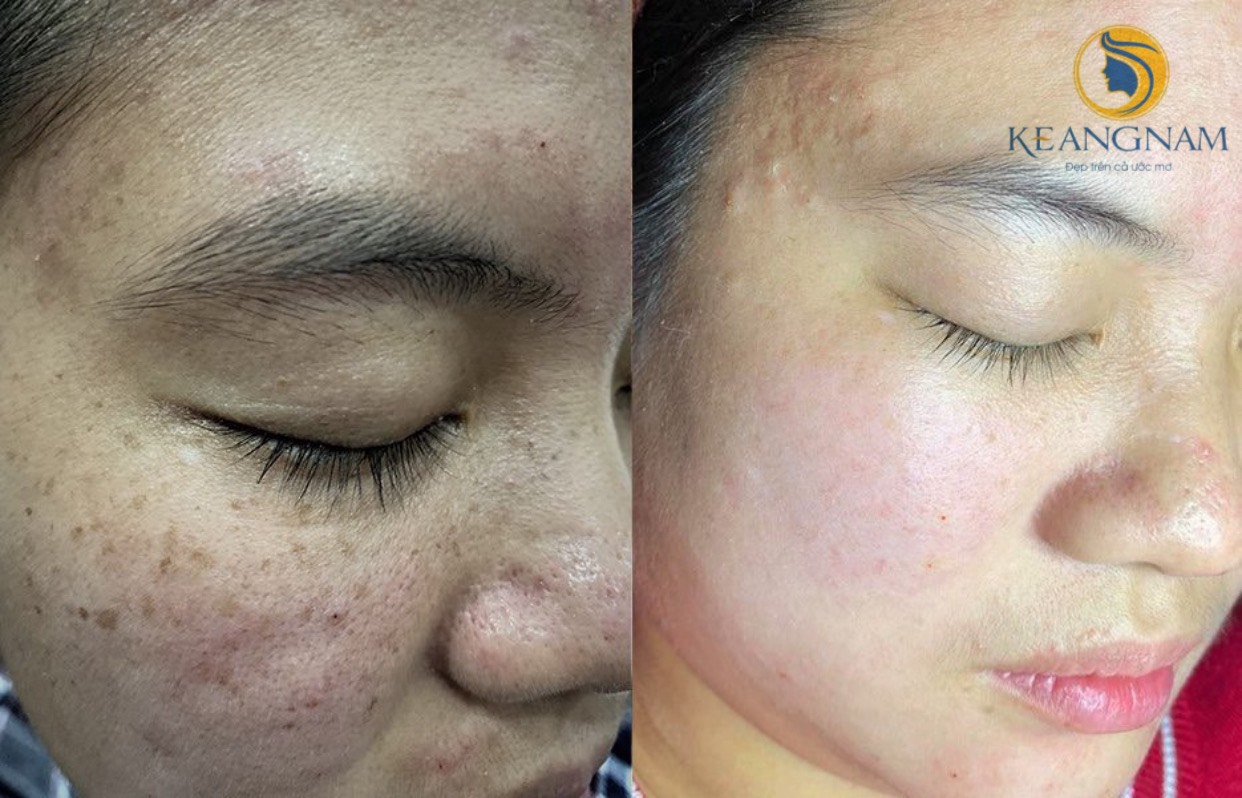 kết quả trước sau của các khách hàng điều trị tại Thẩm Mỹ Keangnam Sóc Sơn số 4