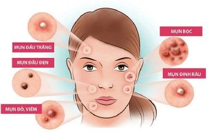 Không biết mụn là gì?