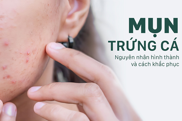 Mụn trứng cá là gì?